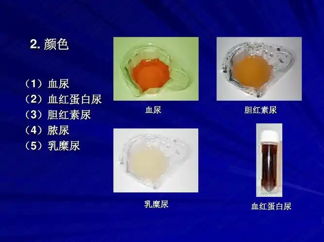 颜色 (1)血尿 (2)血红蛋白尿 (3)胆红素尿 (4)脓尿 (5)乳糜尿 血尿