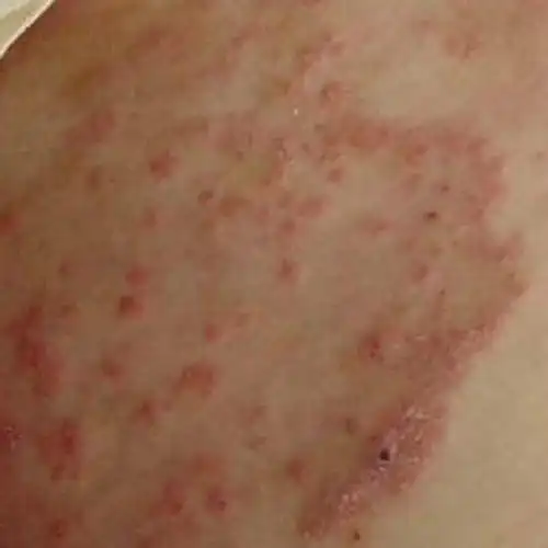 这是杜绝女性患者复发的重要措施之一4合理用药 霉菌性阴道炎是由霉菌