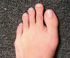 希腊脚是怎么回事