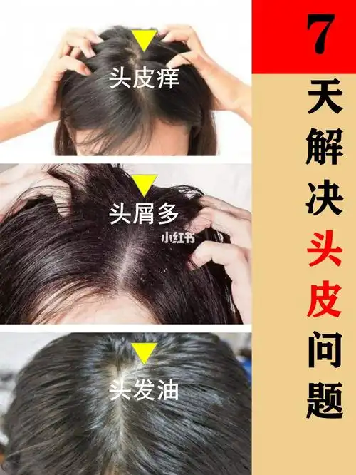 18款哪个去头皮屑头油管用脂溢性皮炎