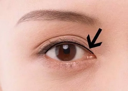 眼睑线的玄机