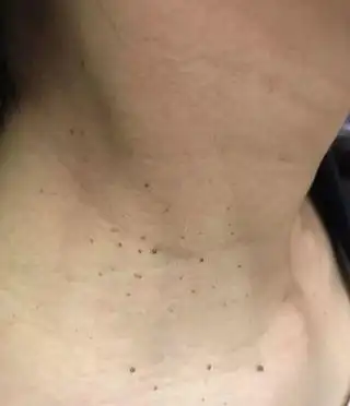 脖子丝状疣初期图片 - 搜狗图片搜索