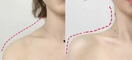 斜方肌粗大,想要体态好可以尝试瘦肩针~夏季到了,很_圈子-新氧美容