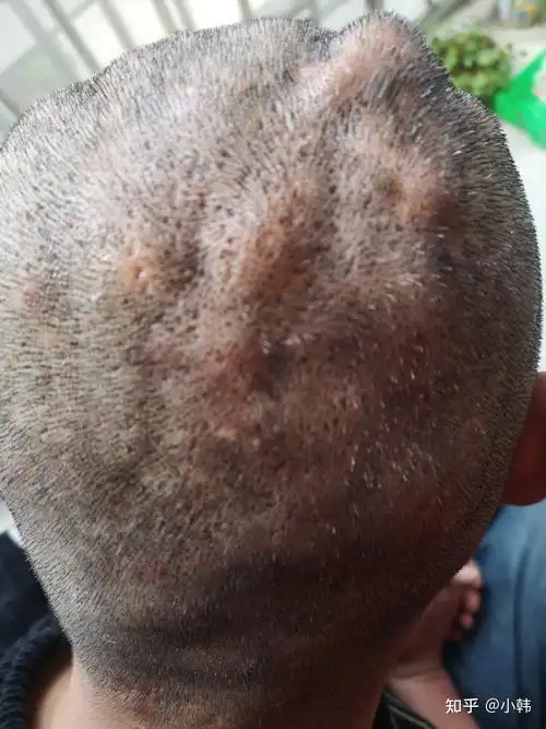 头上起疙瘩是普外还是皮肤科哪个城市哪个医院是专治