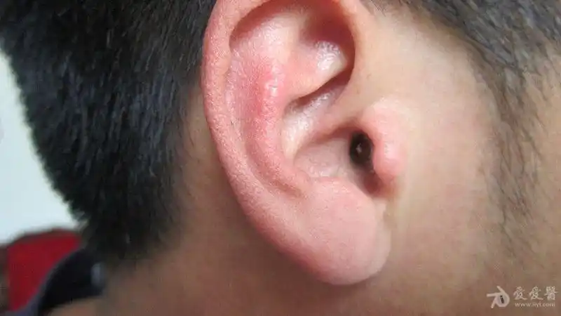 鼻翼,耳廓对称的丘疹——急性湿疹