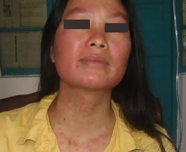 双下肢皮肤溃疡,瘙痒,疼痛,渗出1年(图片)