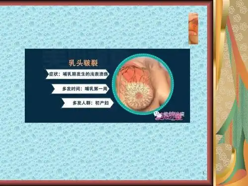 乳头皲裂的日常护ppt课件