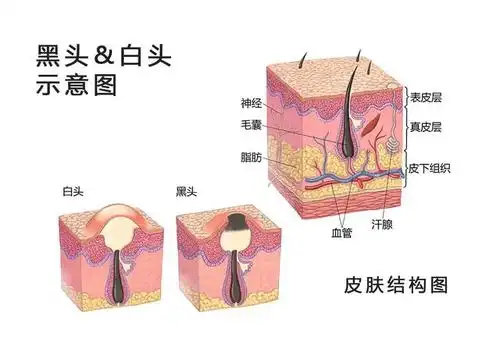 皮肤结构及黑头白头示意图