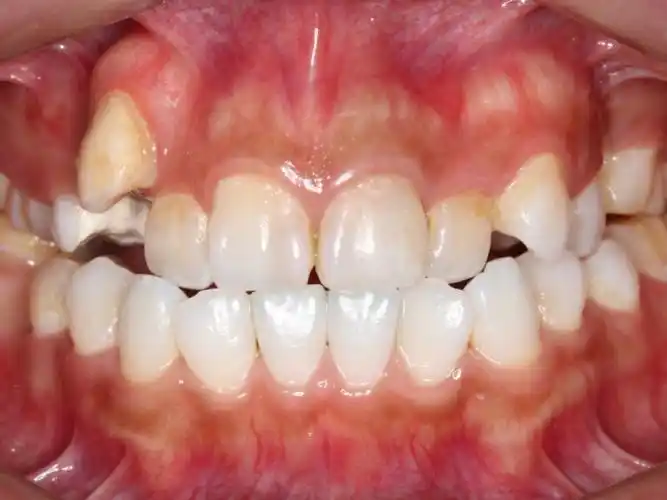 我牙齿最大问题就是虎牙移位了,本来打算做隐形矫正,_圈子-新氧美容