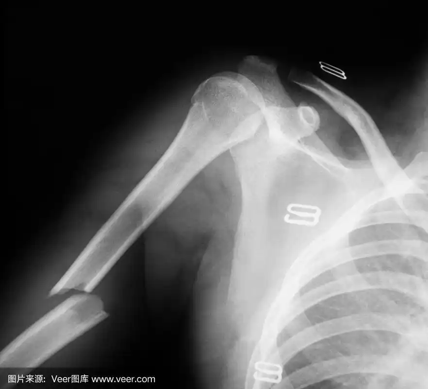 肱骨x线照片,侧位.