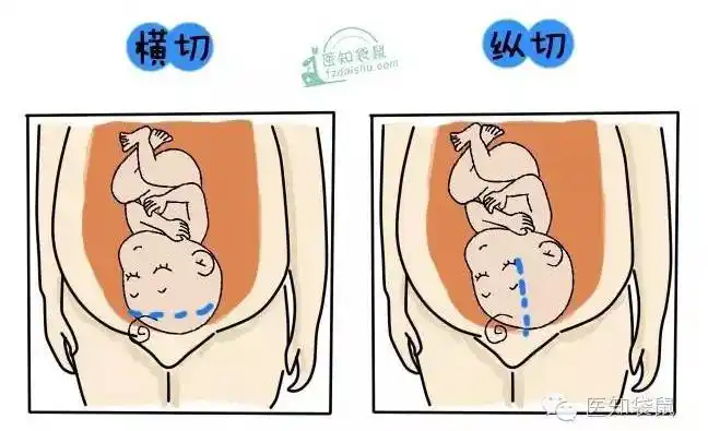 揭秘:剖宫产手术全过程