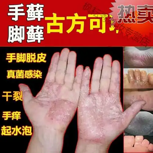 治的疗汗疱疹疱手藓的膏湿的疹鹅掌风手癣膏手足癣真的菌感染脱皮水泡
