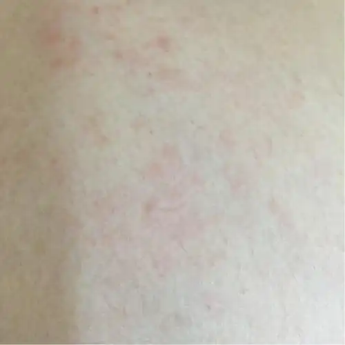 怀孕3个月,肚皮上长处红色斑点,很痒