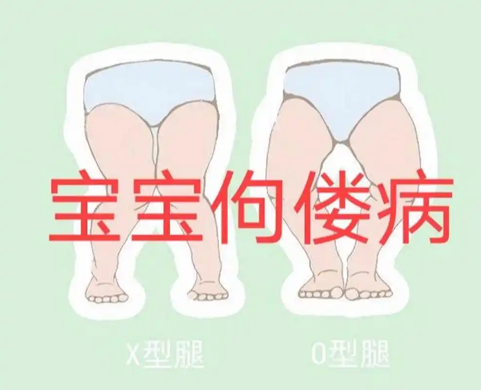 其实佝偻病不光是只有骨骼症状,还有其他症状 93佝偻病活动期症状