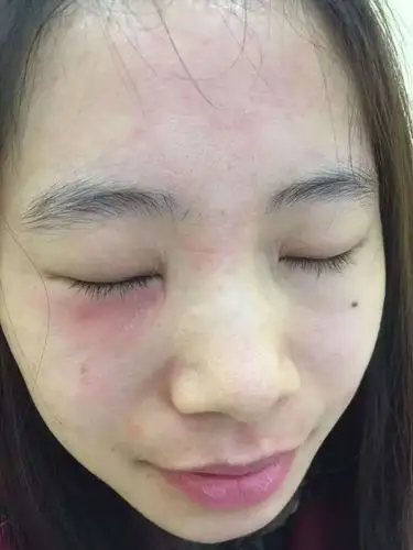 皮肤屏障受损所带来的皮肤问题