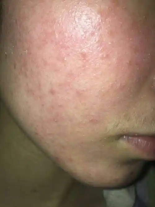 激素依赖性皮炎面部红斑的形成原因及解决办法