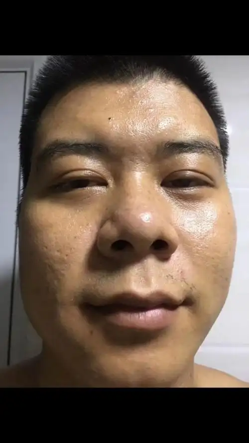 94 男士改善大油脸反馈7716615  图16615满脸油光 图2