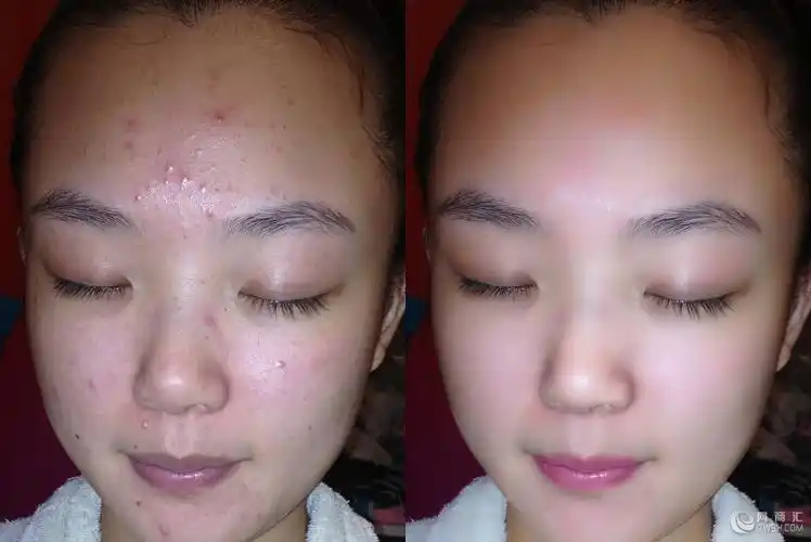 【供应】杭州太和堂祛痘效果怎么样