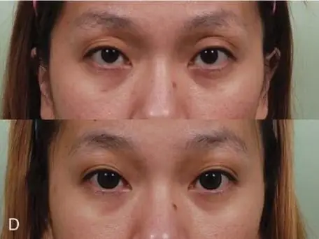 眶周年轻化:精确控制自体脂肪移植量