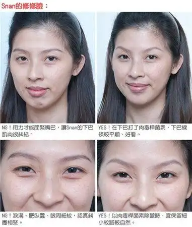 前后对比图此外,也要提醒的是,太爱大笑的人,因为,会不断牵动脸部的