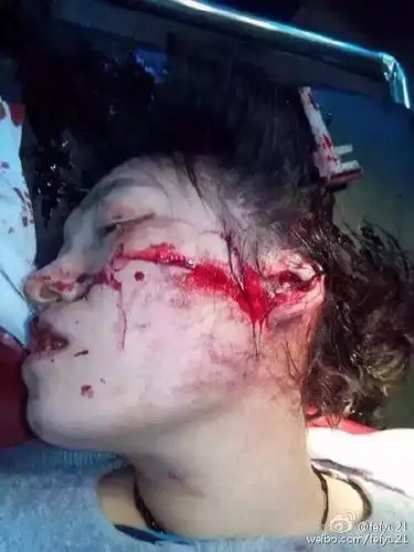 1点多,一名身着深色上衣的女子在长葛市人民医院将一名年轻女医生砍伤