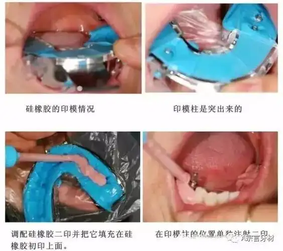 种植医生的好帮手最新种植取模专用托盘