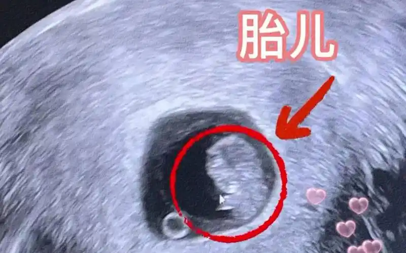 孕早期,胎宝宝刚出胎心胎芽的样子