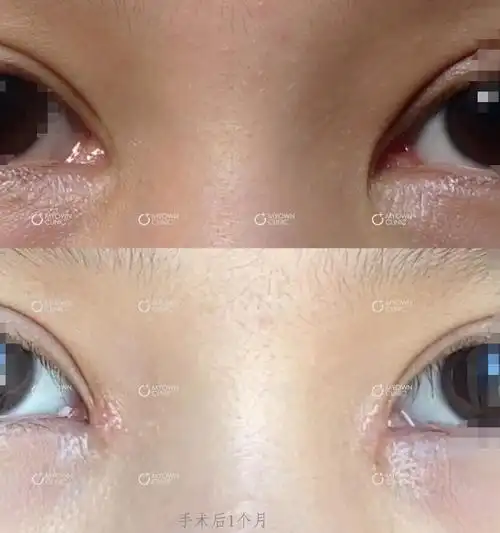 杨东运医生 的想法: 包眼角术后一个月 - 知乎