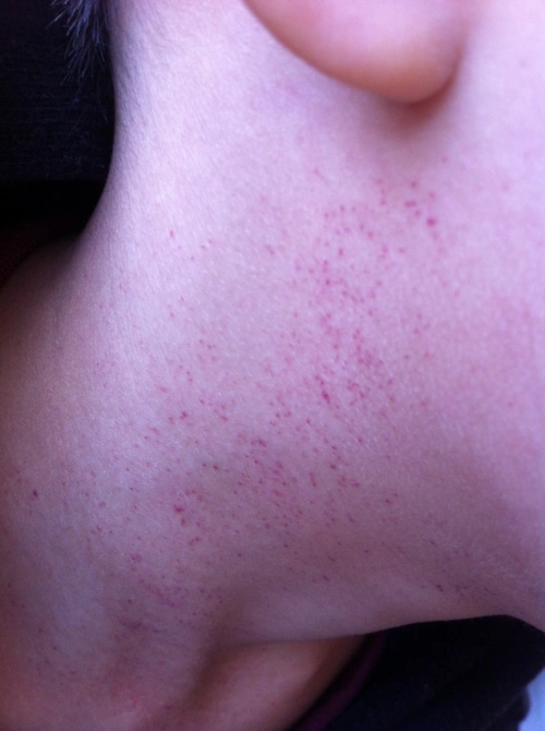 六岁男孩,皮肤上有小血点,请问是怎么回事?谢谢