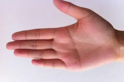 中指长痣图解大全 中指长痣好不好