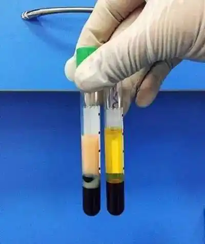 但左侧血脂偏高人群的血浆中,含有大量脂类物质,呈现浑浊的乳糜状