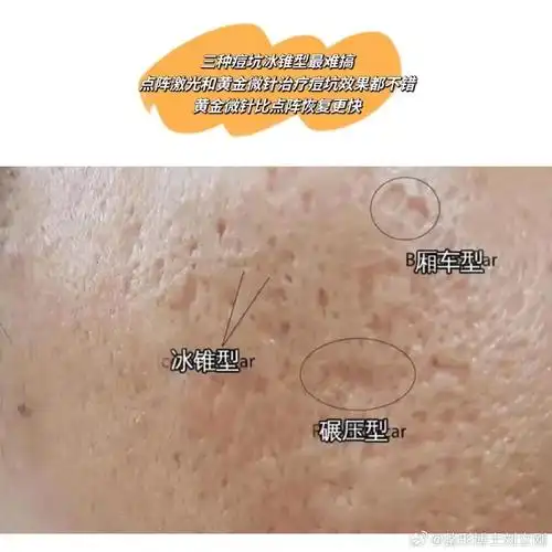 分泌旺盛,另一方面夏天容易出汗,容易滋生细菌;长痘了别挤容易留痘坑