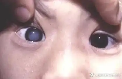 转发3评论4赞6走散在时光里的林教授你好,我宝宝这种是先天白内障吗?