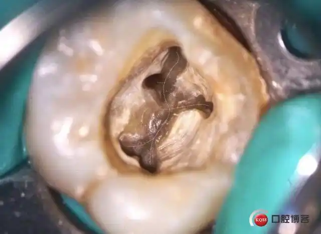 上颌mb2真的存在吗676767