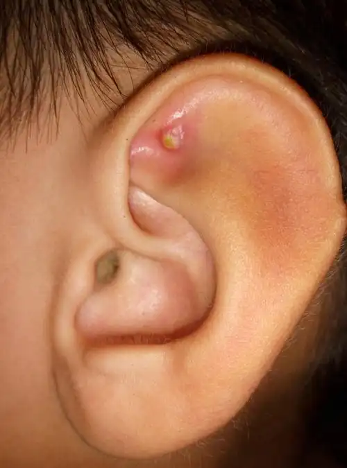 窝处一年前发现有个小米粒大小的包,去医院问了下,医生说是个假性囊肿