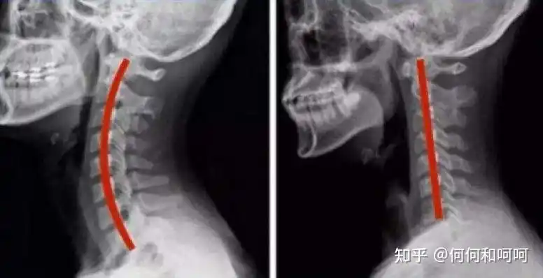 2022年8款高端颈椎枕头测评颈椎曲度变直前倾酸痛应该睡什么样的枕头