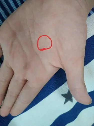前几天发现左手掌中心有个岛纹,怎么办?