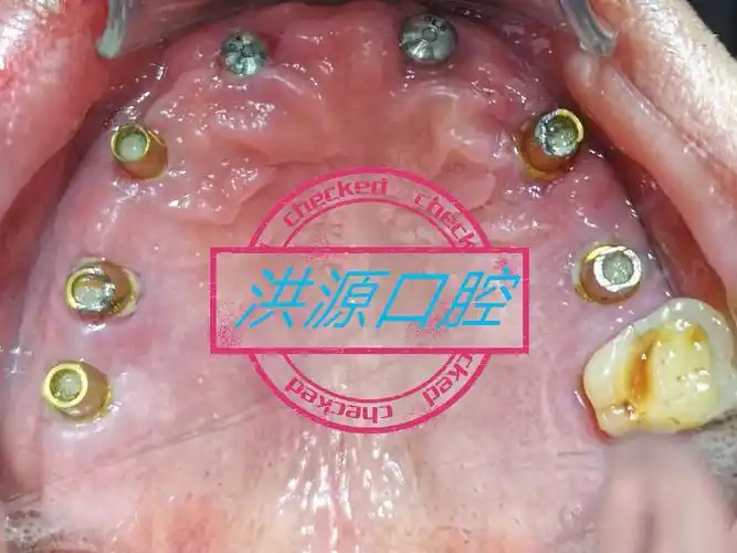 种植牙即刻负重 修复完成一例