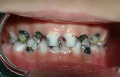 长蛀牙了怎么办