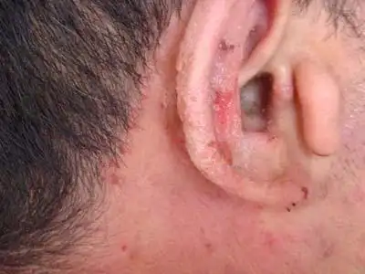 耳湿疹-疾病频道-寻医问药网-xywy.com