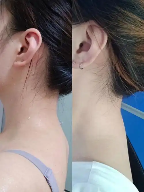 脖子前倾有救嘛