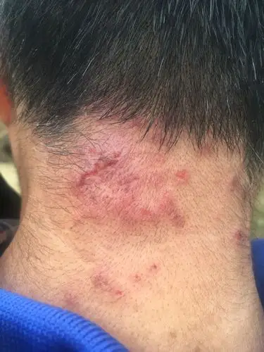 头上长的疙瘩很痒!请问是不是癣啊?用手去挠就出血而且特别痒?