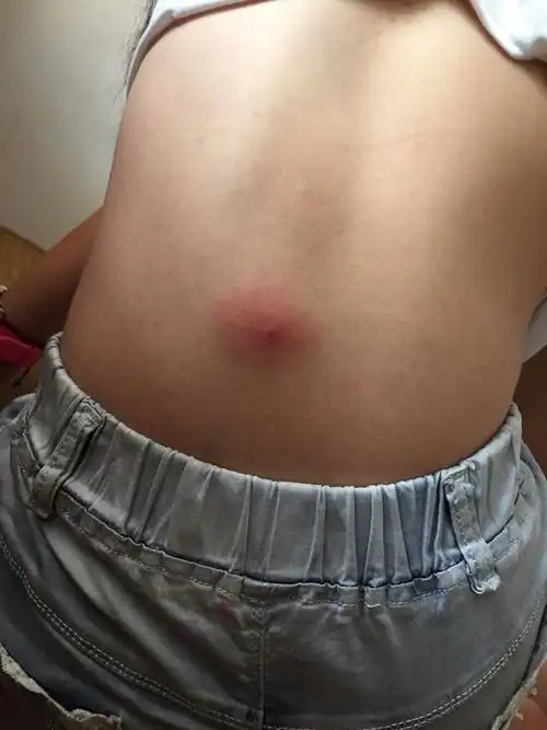 背上长了一个大结子,中间有脓包,摸芦荟水好不
