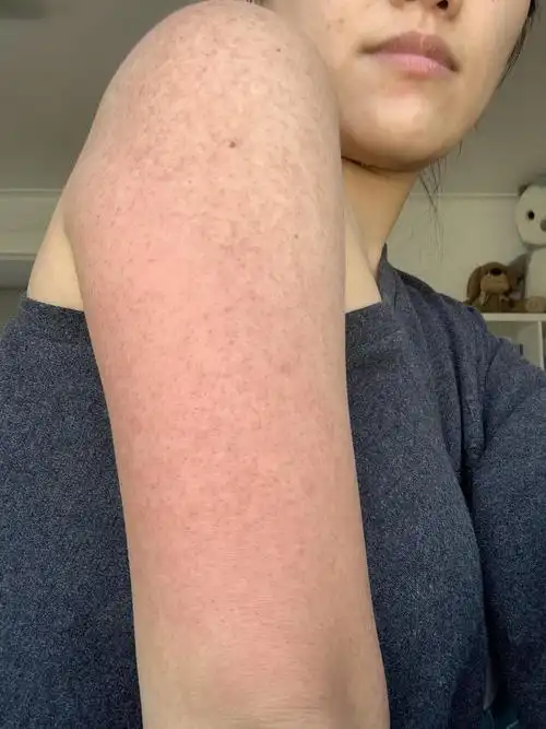 开个贴记录海藻矽针抗鸡皮过程 (姐妹们!我太感动了! .