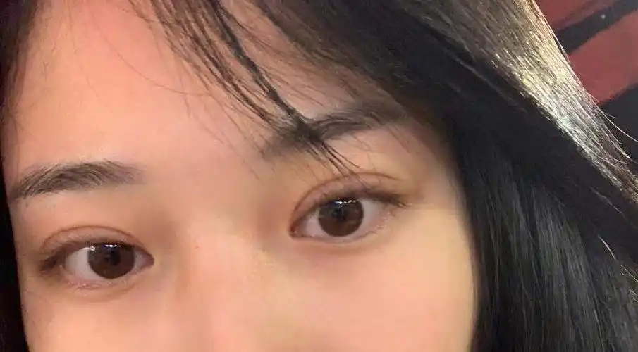 北京割的标准全切扇形双眼皮