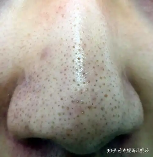 脸上毛孔粗大,应该是油性皮肤,有黑头,有时候会有痘痘有没有好用男士