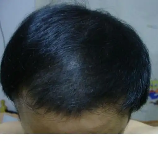 判断是不是正常掉头发要看头发的发根是什么形状的