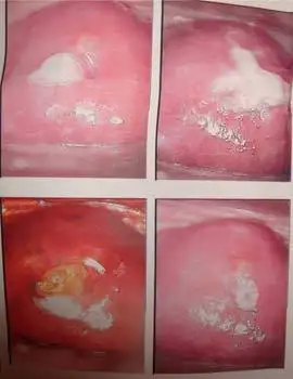 我有霉菌性阴道炎可以做人流吗?点击在线咨询沈阳京科医院专家