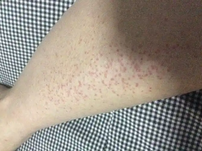 两条腿上都是密密麻麻的红点,不鼓起,不疼不痒,反复_皮肤科_邻医网