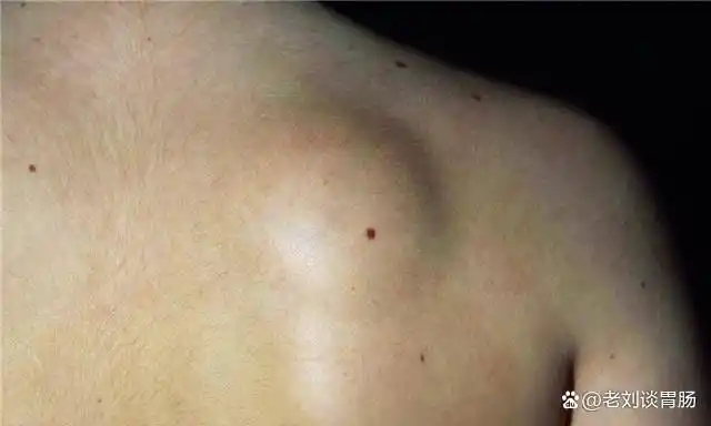 身体表面长出的肉疙瘩是肉瘤吗?